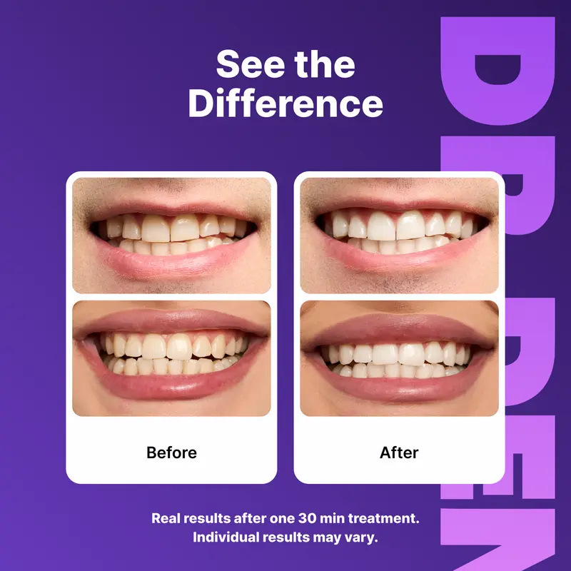 Purple Teeth Whitening Strips - 7/21 Whitening Sessions - Safe for Enamel - Non Sensitive Teeth Whitening - Peroxide-Free